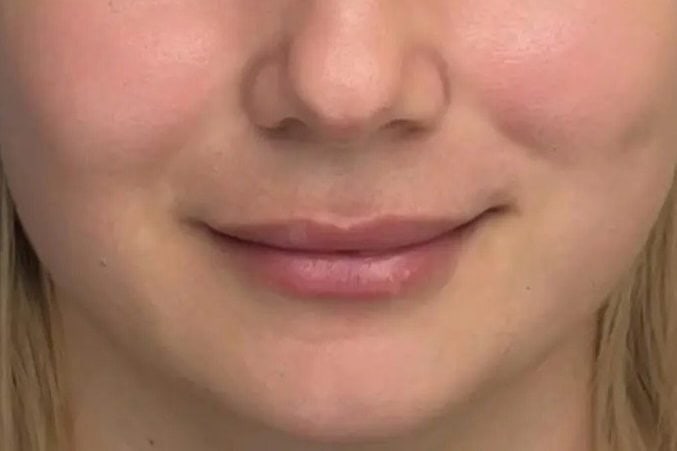 Lippenpigmentierung bei Xenia Frank Salach- sanfte Farbergebnisse Vorher Zustand der Lippen vor einer Lippenpigmentierung Behandlung